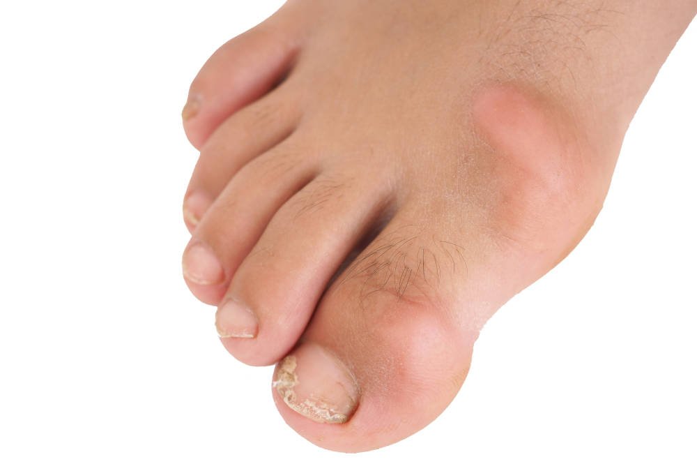 Hallux rigidus