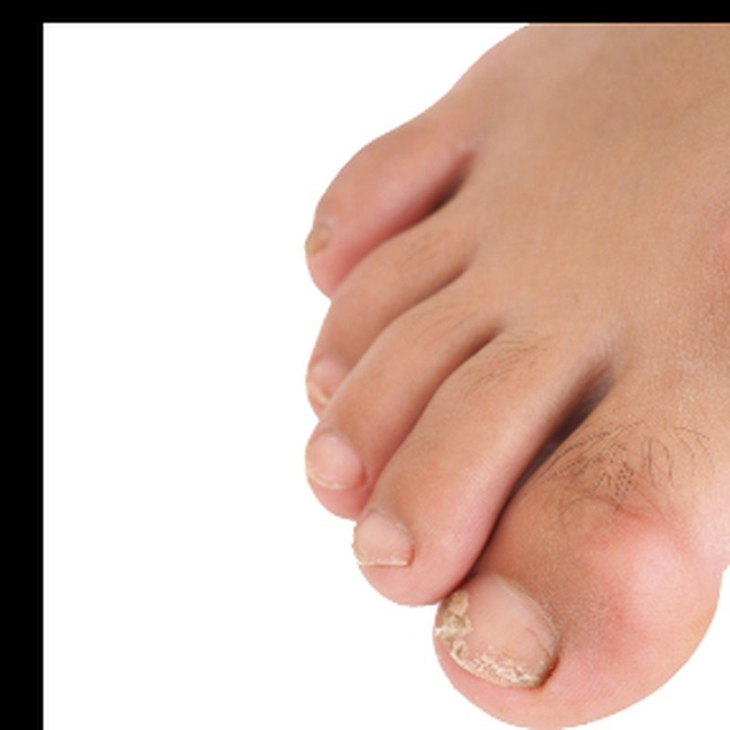 Hallux rigidus