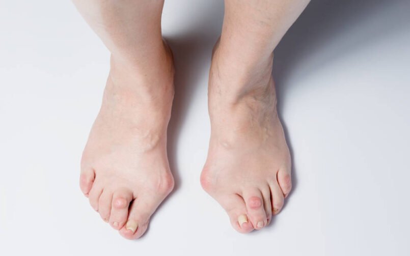 Hallux valgus met scheefstand van de grote teen en knobbel aan de binnenzijde van de voet