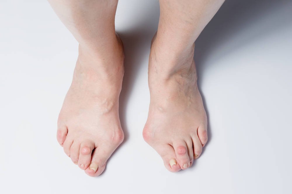 Hallux valgus