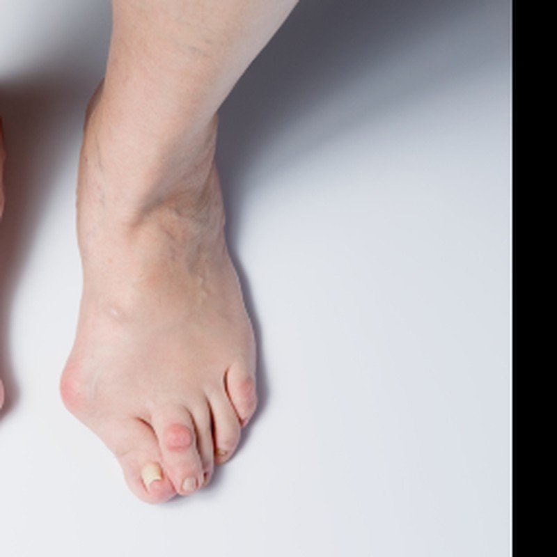 Hallux valgus