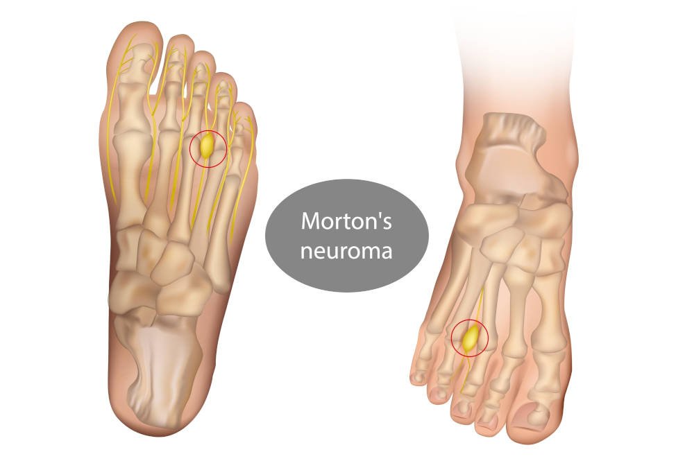 Morton-neuroom
