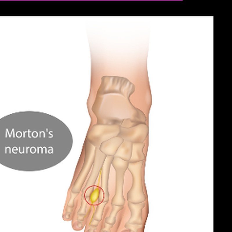 Morton-neuroom