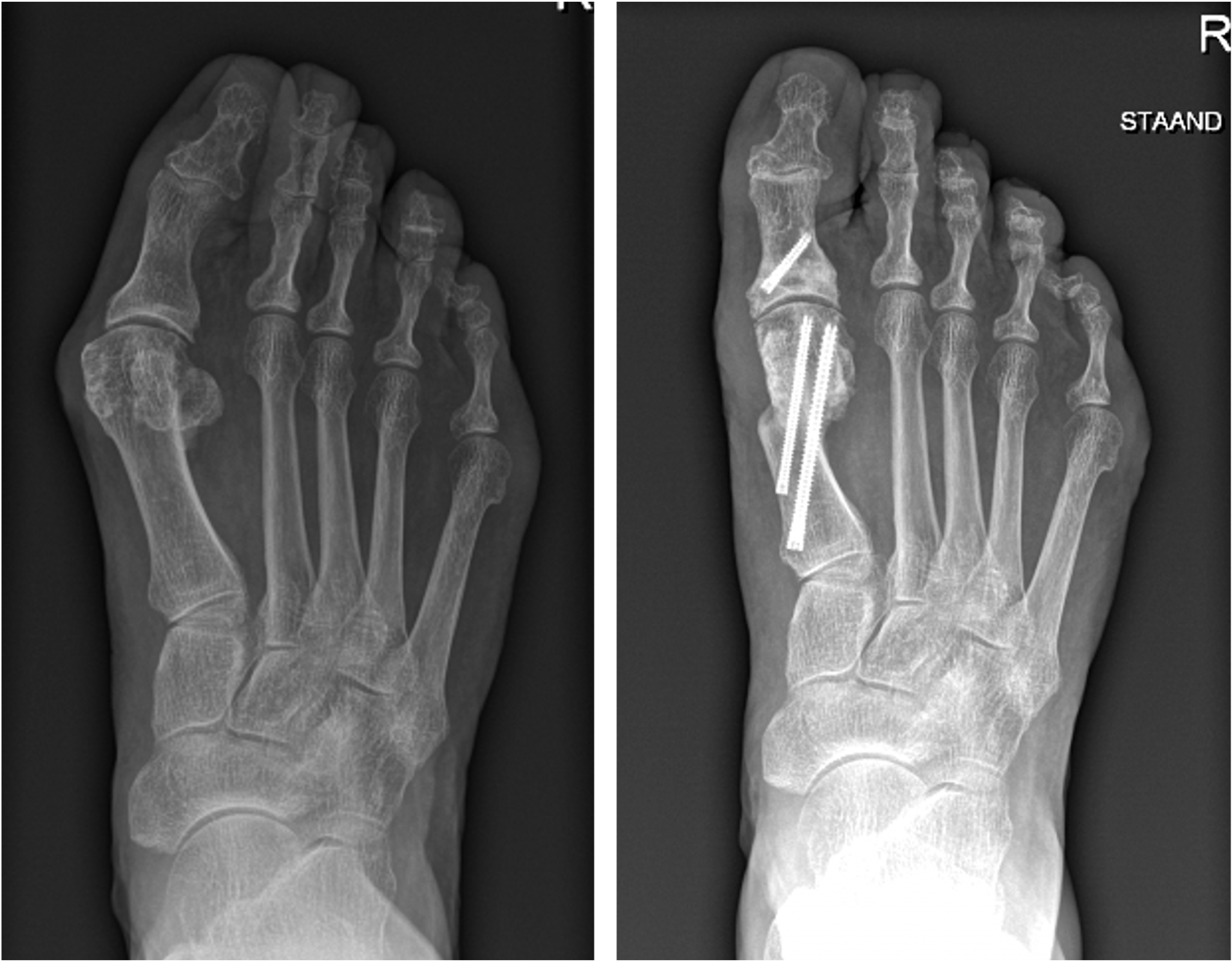 Hallux Valgus Minimaal Invasieve Chirurgie Voet En Enkel Chirurgvoet En Enkel Chirurg