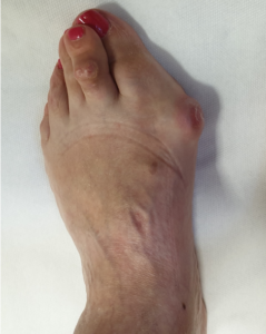 Hallux valgus scheefstand grote teen.